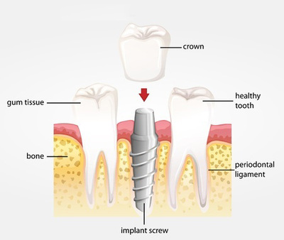 An illustration shows how a dental implant is screwed into the bone with a crown affixed to its post